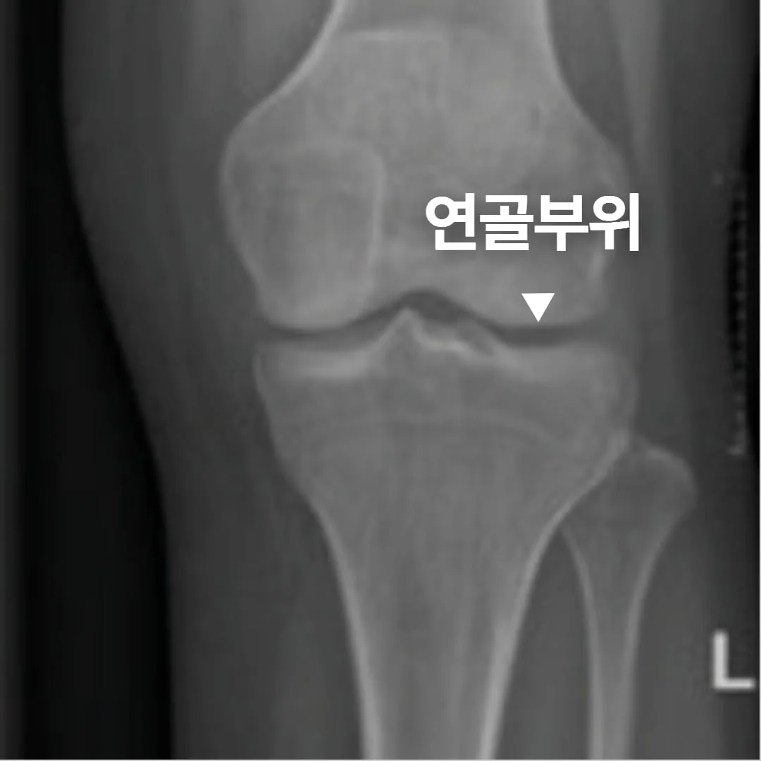 Grade 0 X-ray